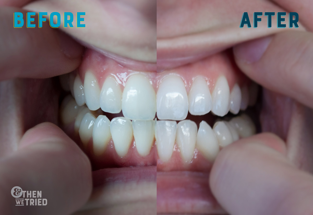 Smile Brilliant Review, our path to the whitest teeth ever and our Smile Brilliant before and after
